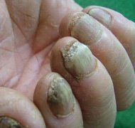 ［太原灰指甲医院］正确认识灰指甲的早期症状有哪些