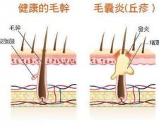 脱发？可能是因为你头上的毛囊发炎了