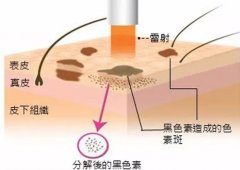 关于激光祛斑你必须知道的那些事