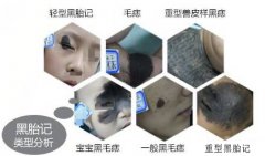 史上最全的胎记类型！激光治胎记立大功