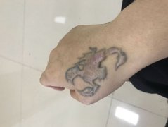 [忻州洗纹身医院]洗纹身时需要注意的那些事！