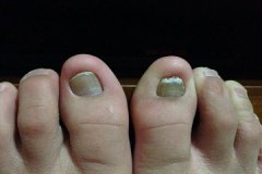 指甲变厚了是灰指甲吗？如何防治灰指甲？