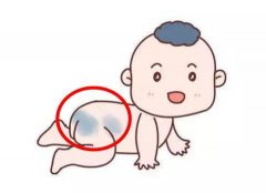 关于宝宝身上的胎记你了解多少？