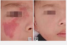 孩子的红色胎记是怎么形成的？