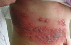 夏季易发带状疱疹，如何预防？