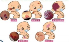 常见的宝宝胎记类型有哪些？