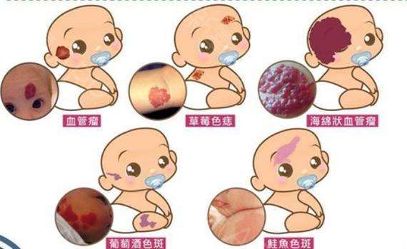 常见的宝宝胎记类型有哪些？