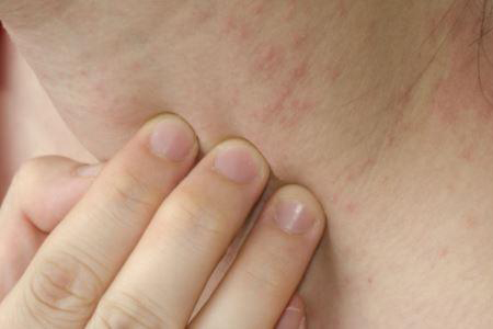 湿疹是因为体内湿气重而引起的吗？