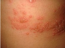 发生带状疱疹哪些人是需要注意的？