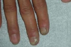 灰指甲是怎么发生的？为什么会得灰指甲？