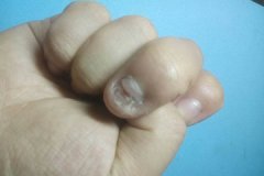 灰指甲那么容易反复发作是因为什么？