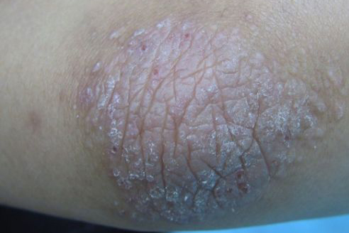 神经性皮炎是怎样的皮肤病？如何预防？