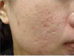 脸上长痘痘的治疗方法，怎么预防脸上长痘痘？