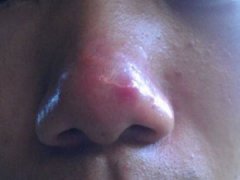 怎么才能清除脸上的青春痘又不伤害皮肤？