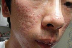 痘痘是一种普遍的炎症性皮肤疾病，由排出来的皮脂腺阻塞形成