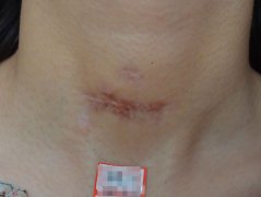 皮肤外伤恢复期容易留下疤痕，脸部伤口不能用碘酒消毒
