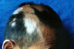 女性脱发怎么预防?女性脱发病因有哪些?产后为什么会导致脱发?
