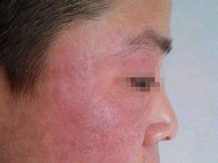 什么原因导致脸部皮炎,脸上皮炎喝什么药?