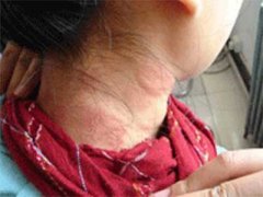 传染性湿疹皮炎有治吗,传染性湿疹皮炎的治疗方式