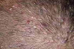 头部脂溢性皮炎会传染吗,头皮脂溢性皮炎可以根治吗?
